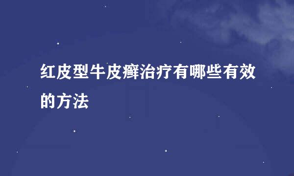 红皮型牛皮癣治疗有哪些有效的方法